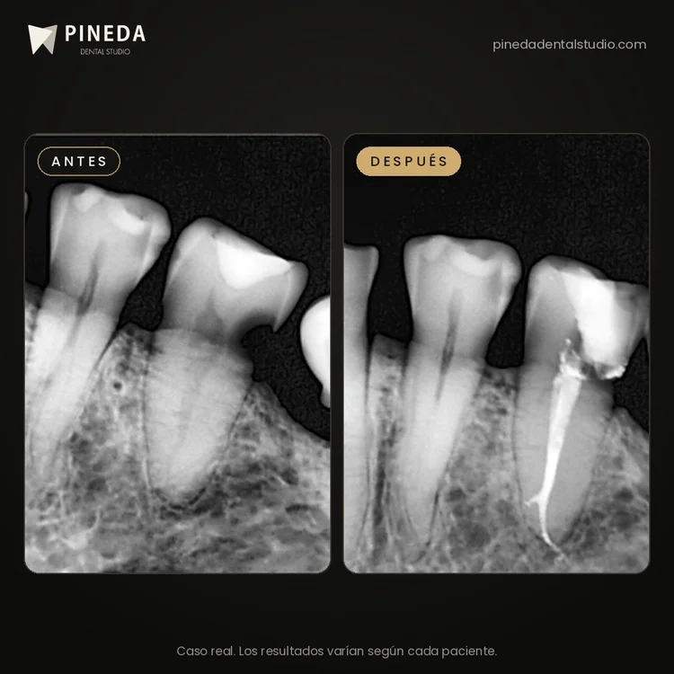 Radiografías antes y después de un tratamiento de conducto por infección en Pineda Dental Studio, Recoleta, CABA.