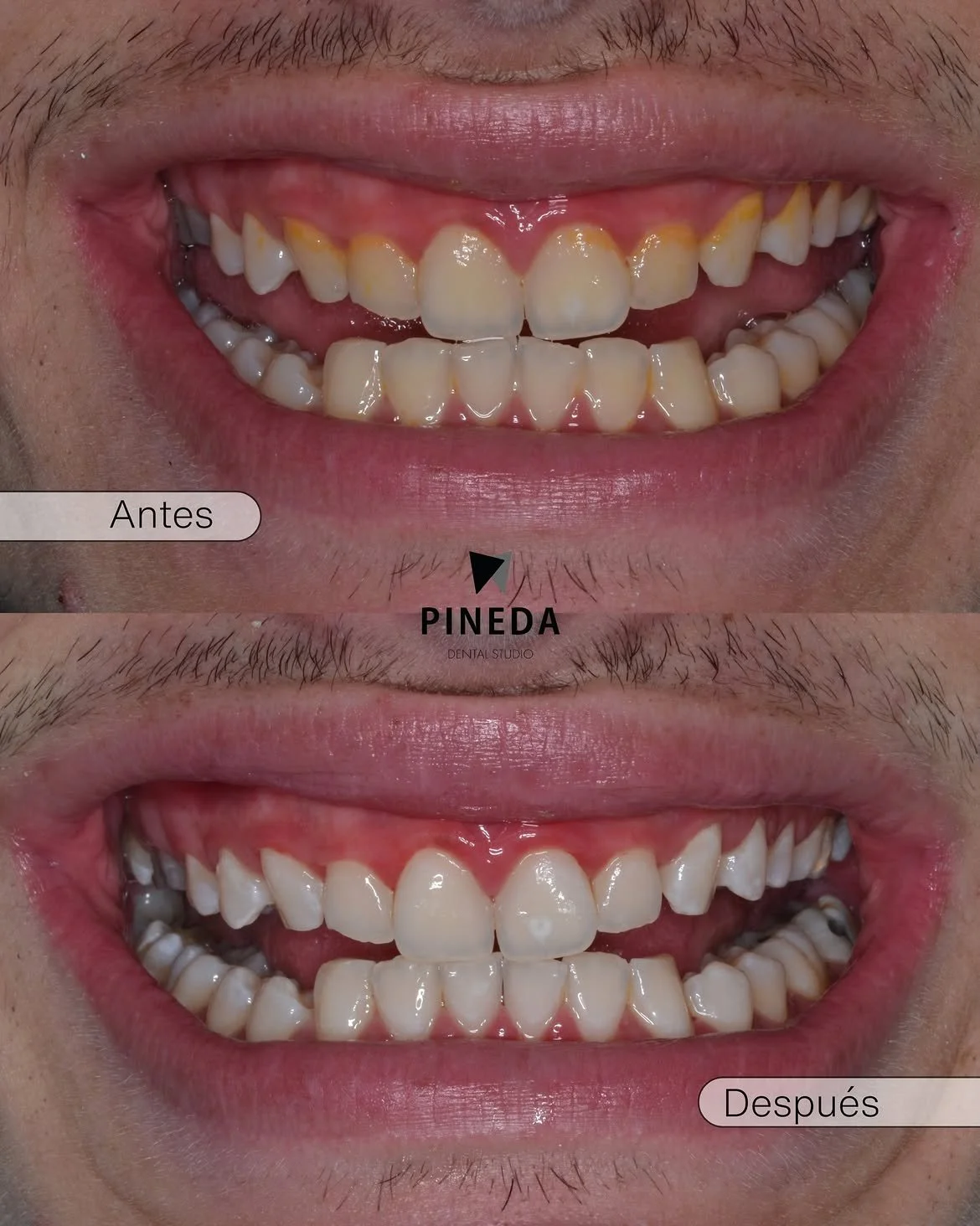 BLANQUEAMIENTO DENTAL CLÍNICO