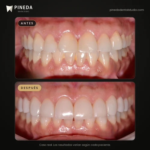 Antes y después de carillas de composite sin desgaste en Pineda Dental Studio, Recoleta, CABA
