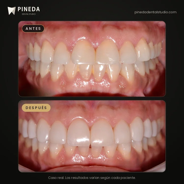Antes y después de un diseño de sonrisa con carillas de composite sin desgaste en Pineda Dental Studio, Recoleta, CABA.