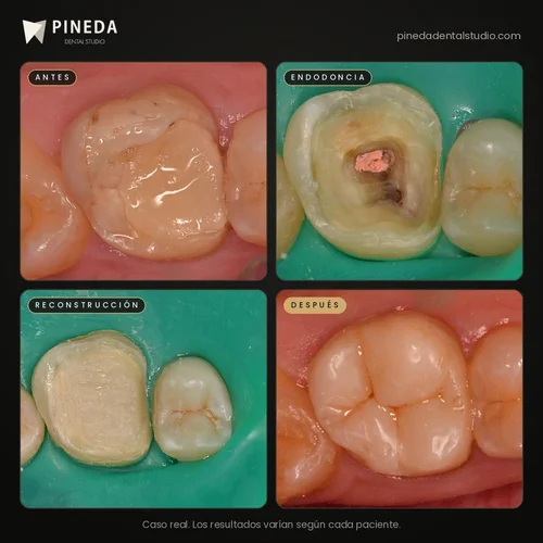 Antes, durante y después de una endodoncia y reconstrucción de muela en Pineda Dental Studio, Recoleta, CABA