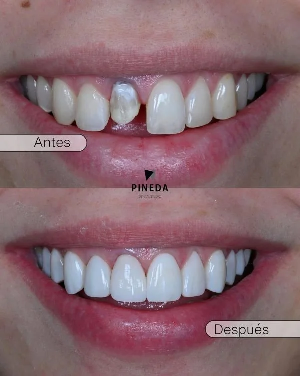 Planificación digital de coronas y carillas dentales en Pineda Dental Studio, mostrando los tiempos de tratamiento estético en Recoleta para pacientes locales y extranjeros.