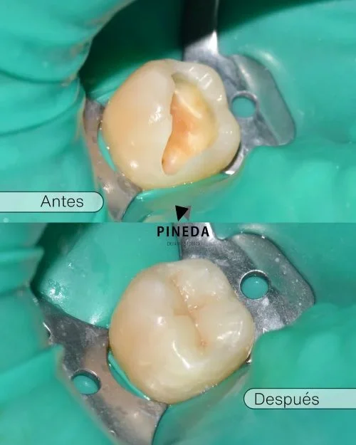 Comparativa clínica de una incrustación dental en composite realizada bajo aislamiento absoluto en Pineda Dental Studio, Recoleta Capital Federal, para recuperar la estructura de un molar severamente dañado