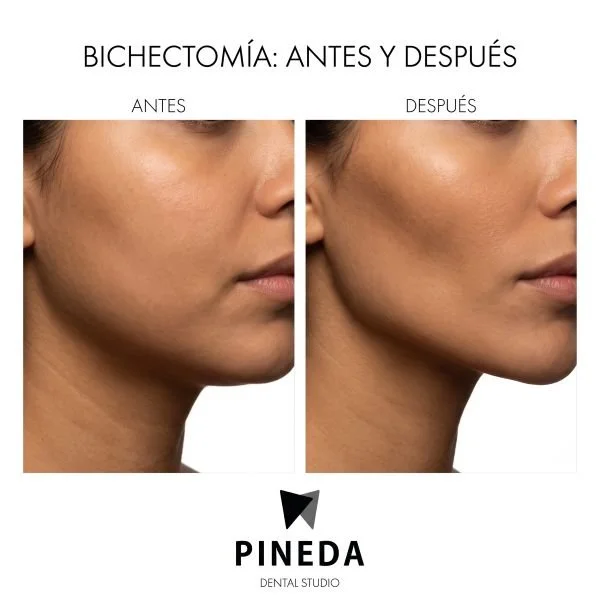Antes y después de una bichectomía: mejillas más definidas y pómulos resaltados