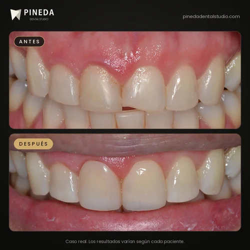 Before and after composite veneers on the front teeth at Pineda Dental Studio, Recoleta, Buenos Aires