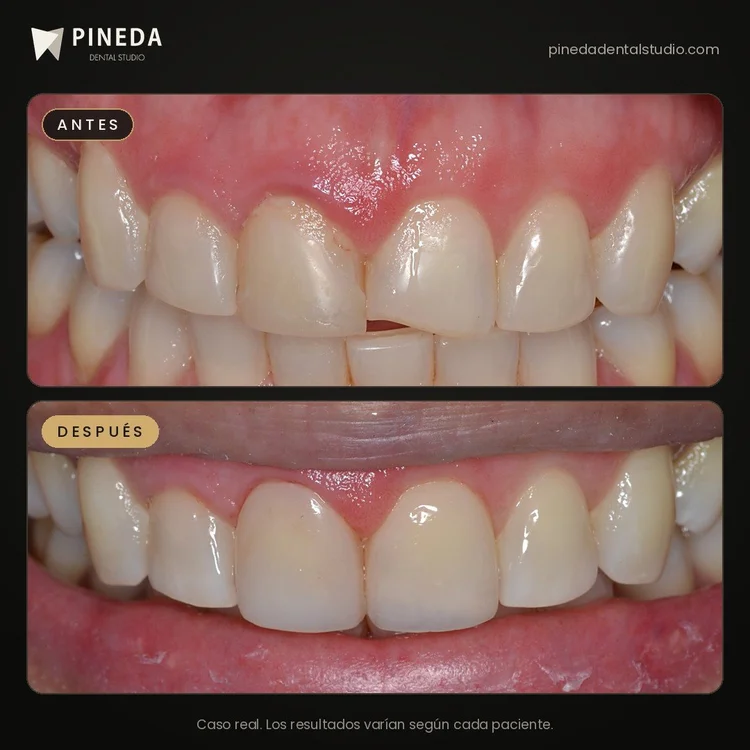 Antes y después de carillas de resina en los dientes anteriores en Pineda Dental Studio, Recoleta, CABA.