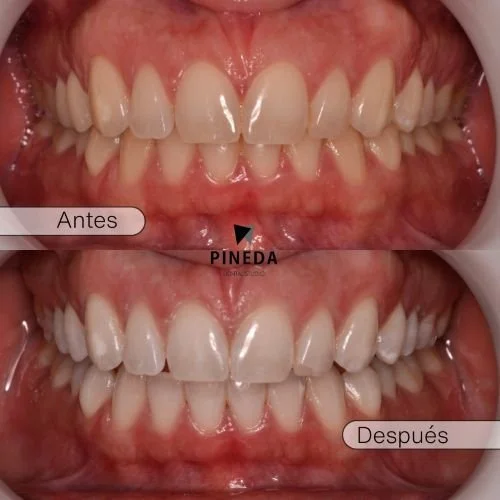 Antes y después de blanqueamiento dental LED profesional en paciente de Pineda Dental Studio, Recoleta, CABA