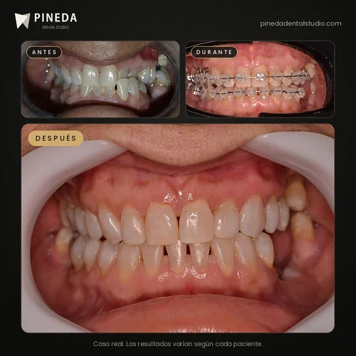 Antes, durante y después de una ortodoncia con brackets de zafiro en Pineda Dental Studio, Recoleta, CABA