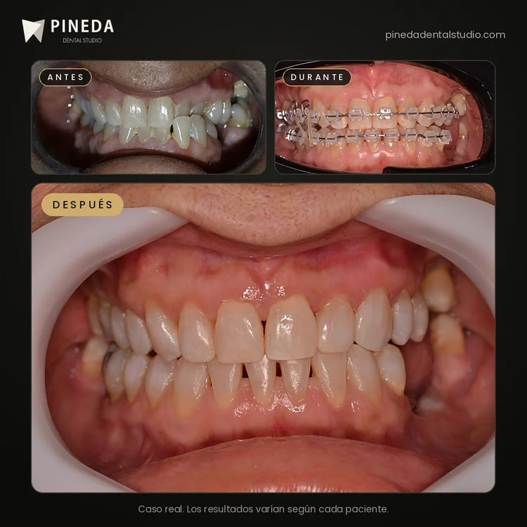 Antes, durante y después de una ortodoncia con brackets de zafiro en Pineda Dental Studio, Recoleta, CABA.