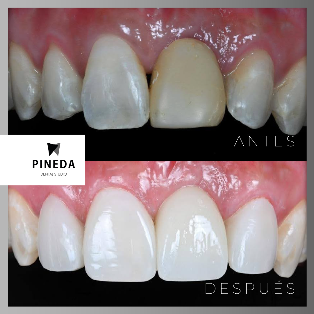 DISEÑO DE SONRISA CON CARILLAS Y CORONAS DE PORCELANA