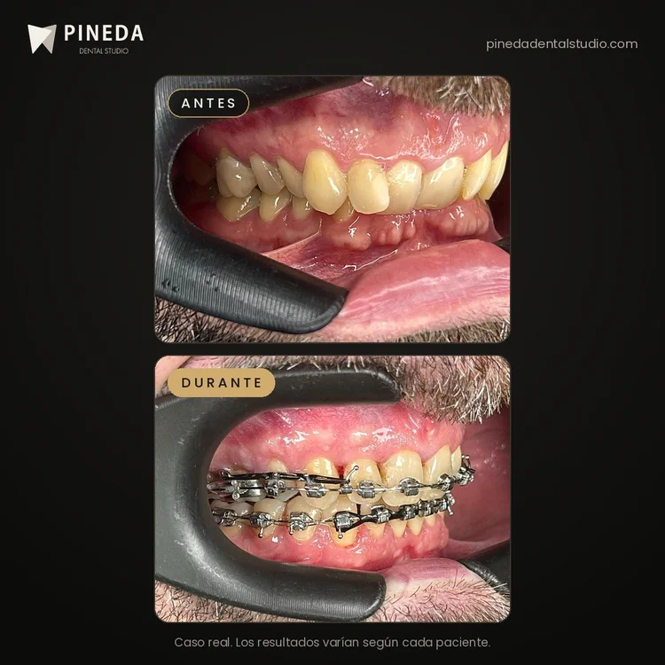 Antes y durante un tratamiento de ortodoncia con brackets metálicos en Pineda Dental Studio, Recoleta, CABA.
