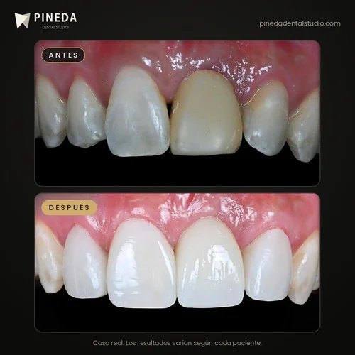 Antes y después de un diseño de sonrisa con carillas de composite y corona de cerámica en Pineda Dental Studio, Recoleta, CABA