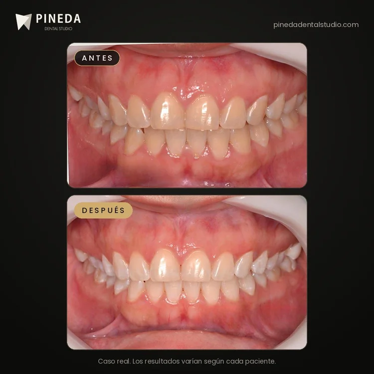 Antes y después de una limpieza y blanqueamiento dental en Pineda Dental Studio, Recoleta, CABA.