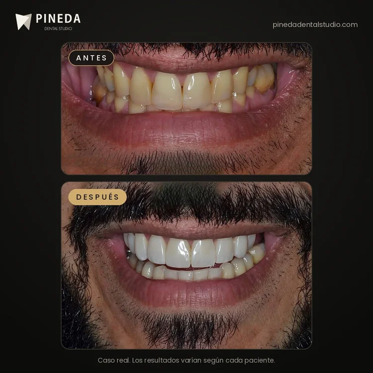 Antes y después de carillas dentales sin desgaste en Pineda Dental Studio, Recoleta, CABA.