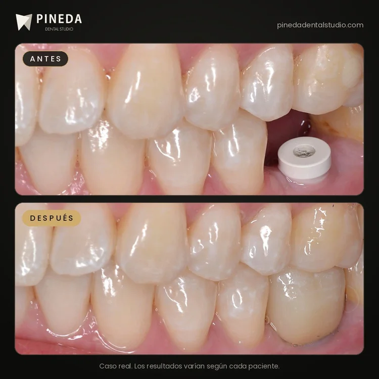 Antes y después de una corona de porcelana sobre implante dental en Pineda Dental Studio, Recoleta, CABA.