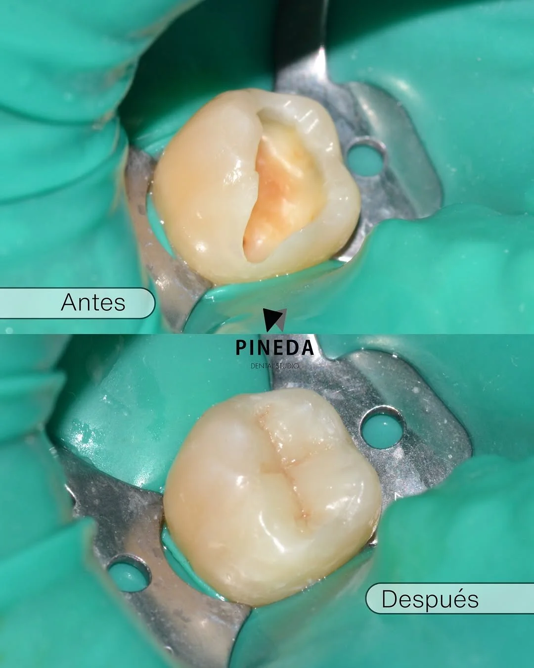 Comparativa de antes y después mostrando dos casos clínicos: una restauración indirecta (incrustación) y una restauración directa con composite, ambas realizadas con aislamiento absoluto en Pineda Dental Studio, Recoleta - CABA.