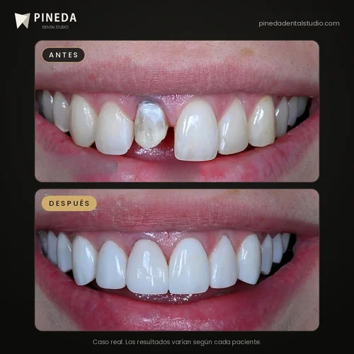 Antes y después de estética dental con carillas en Pineda Dental Studio, Recoleta, CABA