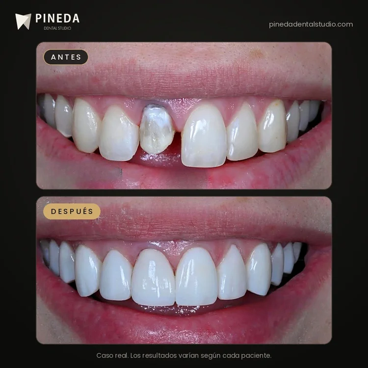 Antes y después de estética dental con carillas en Pineda Dental Studio, Recoleta, CABA.