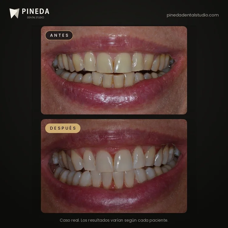 Before and after combined teeth whitening: smile view at Pineda Dental Studio, Recoleta, Buenos Aires.