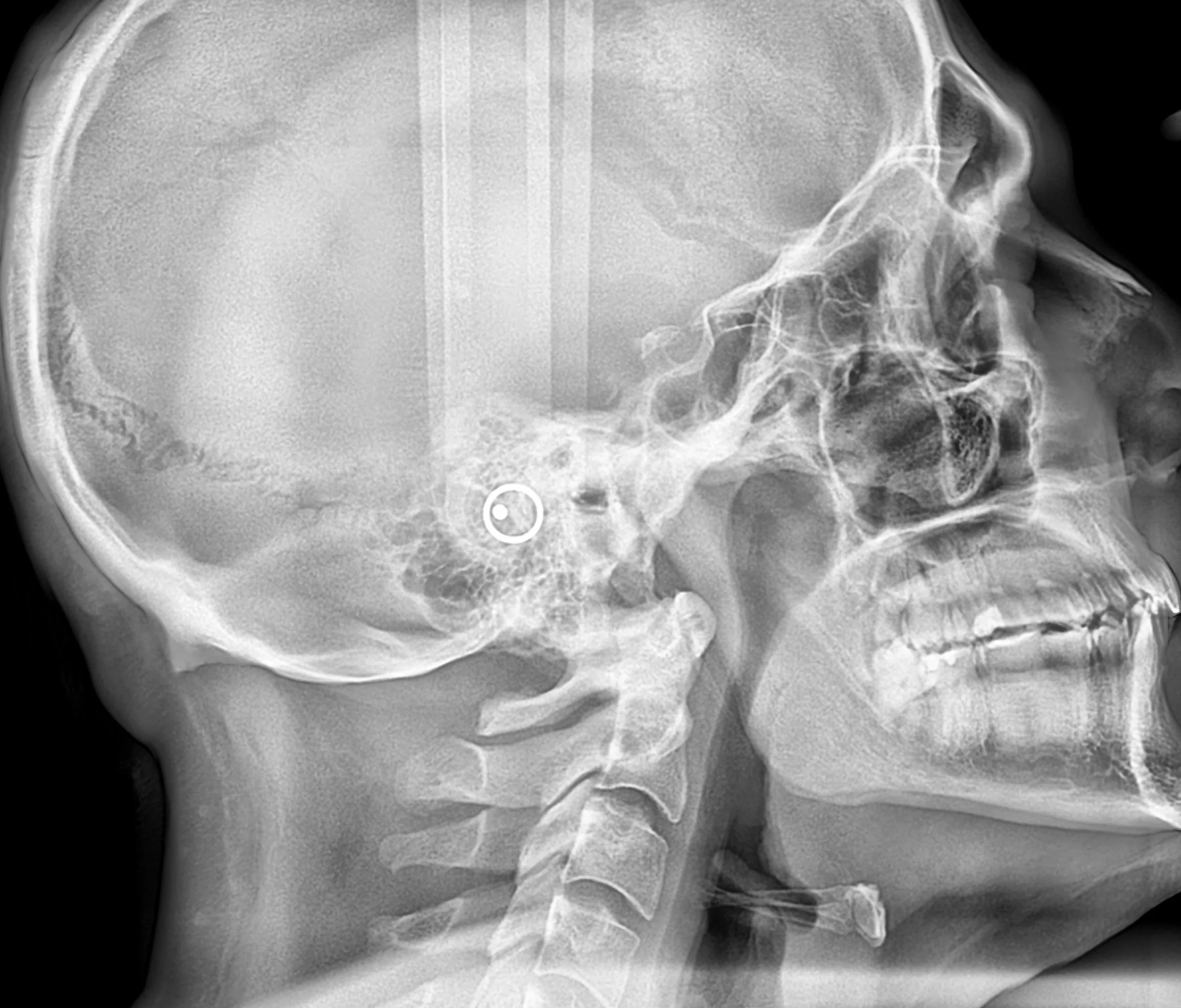 Estudio de radiografía cefalométrica de perfil para diagnóstico de ortodoncia y cirugía maxilofacial en Pineda Dental Studio, Capital Federal