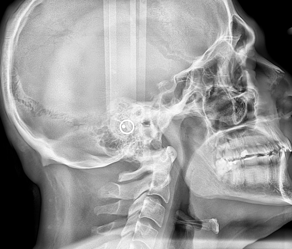 Telerradiografía de perfil digital para el diagnóstico de ortodoncia en Pineda Dental Studio, Recoleta, CABA.