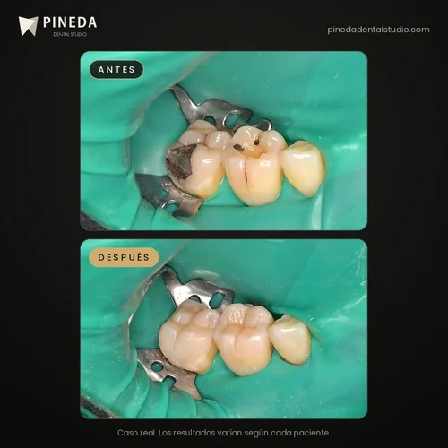 Antes y después del cambio de amalgamas por resinas estéticas en Pineda Dental Studio, Recoleta, CABA
