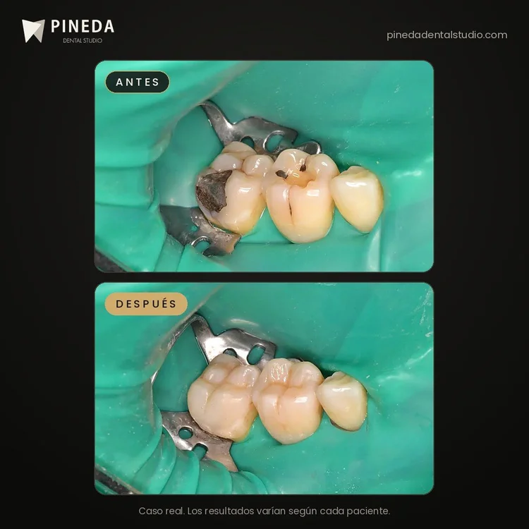 Antes y después del cambio de amalgamas por resinas estéticas en Pineda Dental Studio, Recoleta, CABA.
