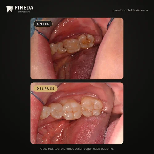 Antes y después de resinas en muelas inferiores en Pineda Dental Studio, Recoleta, CABA