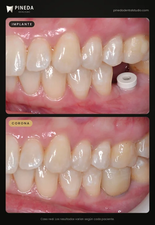 Implante dental con pilar de cicatrización y corona definitiva en Pineda Dental Studio, Recoleta, CABA
