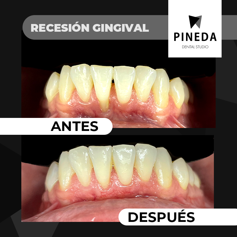 Comparativa de antes y después de un tratamiento de periodoncia para solucionar una recesión gingival severa en Pineda Dental Studio, Recoleta CABA.