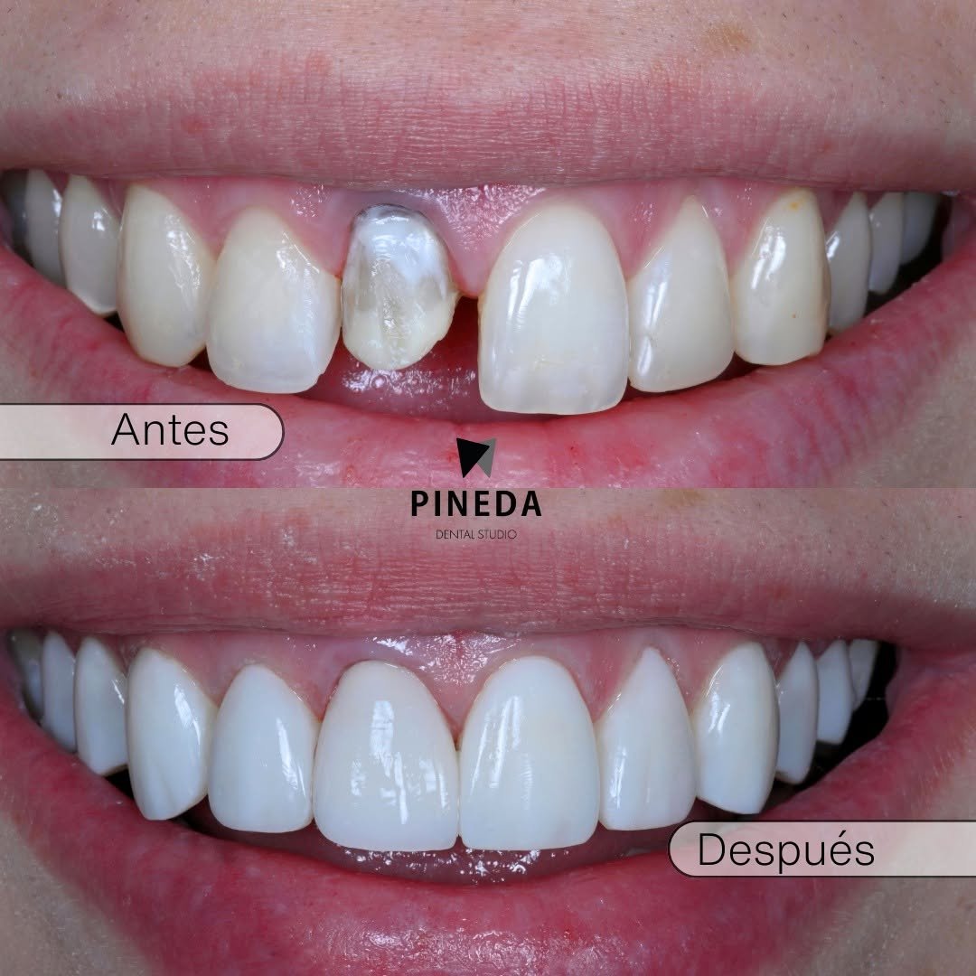DISEÑO DE SONRISA