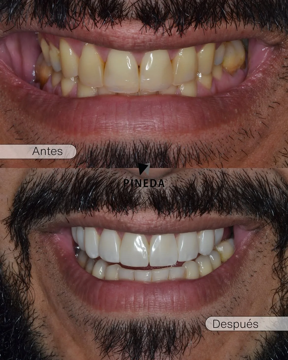 CARILLAS DENTALES SIN DESGASTE