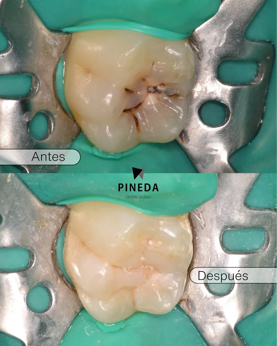 Comparativa de antes y después mostrando dos casos clínicos: una restauración indirecta (incrustación) y una restauración directa con composite, ambas realizadas con aislamiento absoluto en Pineda Dental Studio, Recoleta - CABA
