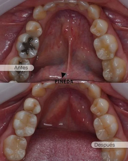 Fotografía clínica intraoral de antes y después mostrando el reemplazo de arreglos oscuros y filtrados de amalgama por resinas estéticas de alta calidad en Pineda Dental Studio, Recoleta.