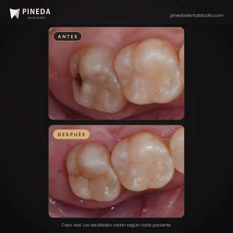 Antes y después de una restauración de resina en un molar en Pineda Dental Studio, Recoleta, CABA.