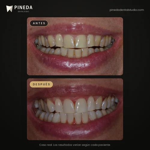 Before and after combined teeth whitening at Pineda Dental Studio, Recoleta, Buenos Aires