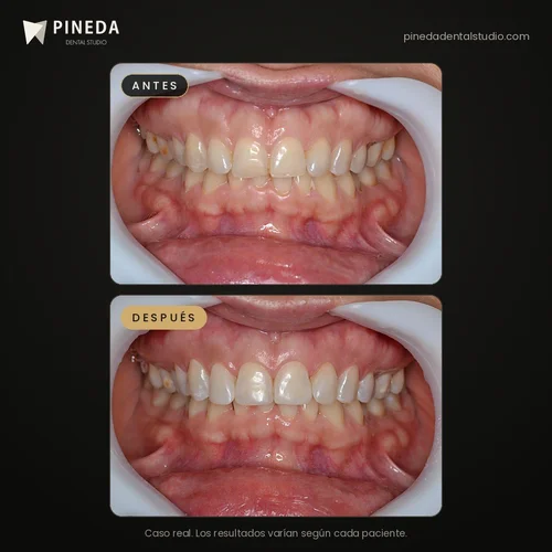 Antes y después de restauraciones estéticas en dientes anteriores en Pineda Dental Studio, Recoleta, CABA