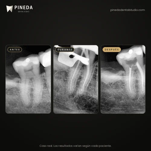 Radiografías antes, durante y después de un tratamiento de conducto en Pineda Dental Studio, Recoleta, CABA