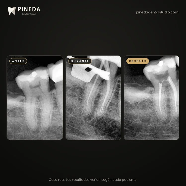 Radiografías antes, durante y después de un tratamiento de conducto en un molar en Pineda Dental Studio, Recoleta, CABA.