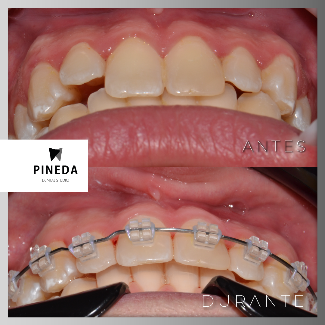 Comparativa de antes y durante un tratamiento de ortodoncia fija estética con brackets transparentes en Pineda Dental Studio, Recoleta - CABA