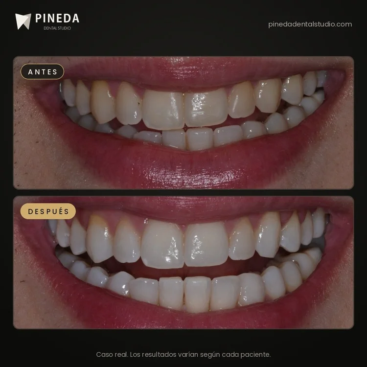 Antes y después de un blanqueamiento dental: vista de la sonrisa en Pineda Dental Studio, Recoleta, CABA.