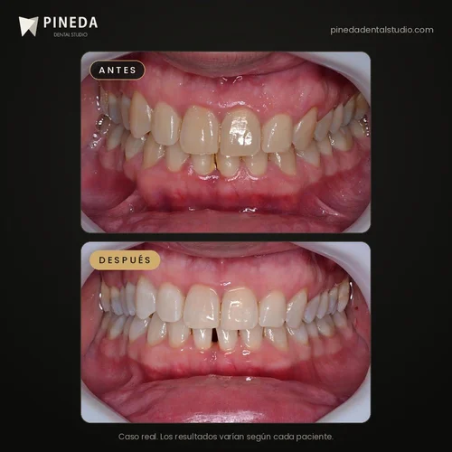 Antes y después de una limpieza profunda y blanqueamiento dental en Pineda Dental Studio, Recoleta, CABA