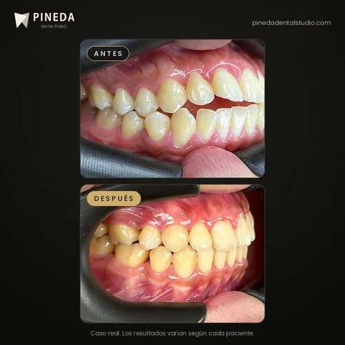 Antes y después de la corrección de una mordida abierta con ortodoncia en Pineda Dental Studio, Recoleta, CABA