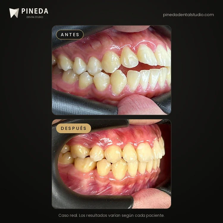 Antes y después de la corrección de una mordida abierta con ortodoncia en Pineda Dental Studio, Recoleta, CABA.