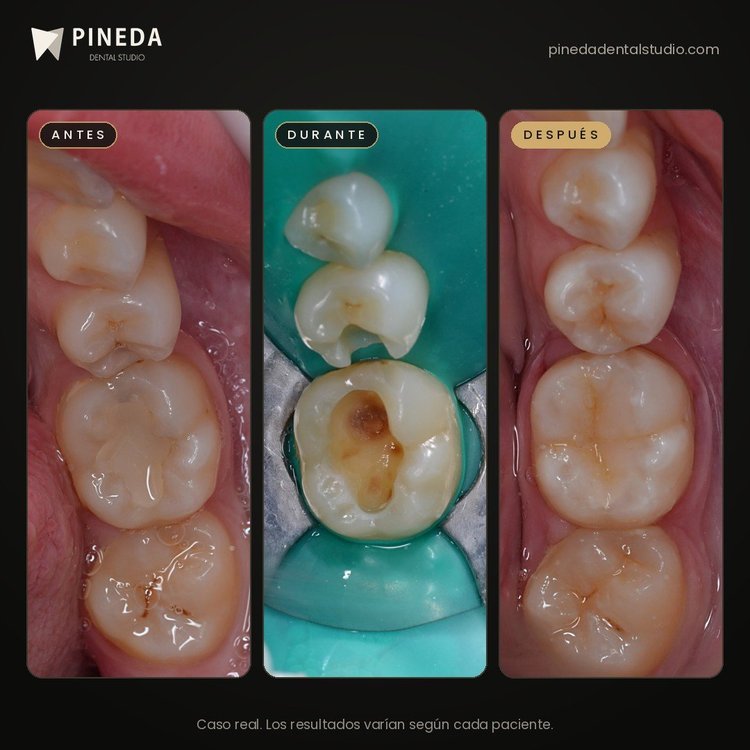 Antes, durante y después de restauraciones de resina en molar y premolar en Pineda Dental Studio, Recoleta, CABA.