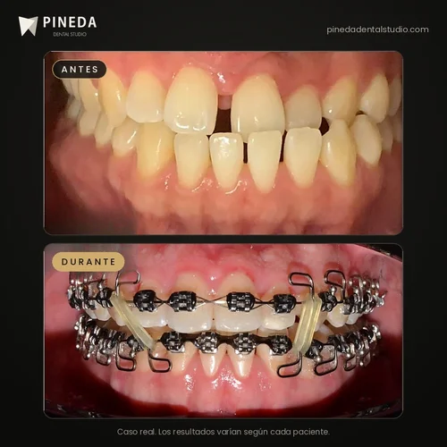 Antes y durante un tratamiento de ortodoncia metálica en Pineda Dental Studio, Recoleta, CABA