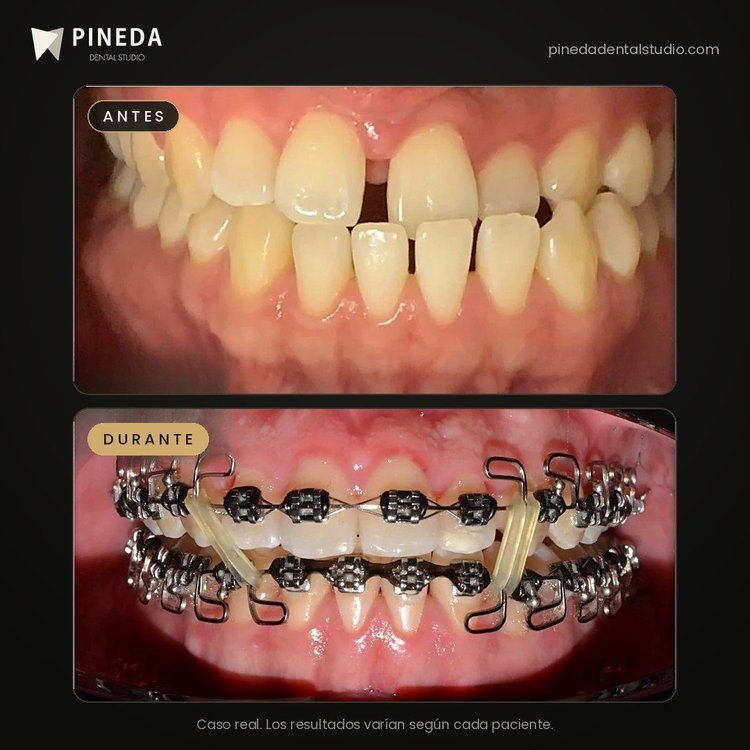 Antes y durante un tratamiento de ortodoncia metálica en Pineda Dental Studio, Recoleta, CABA.
