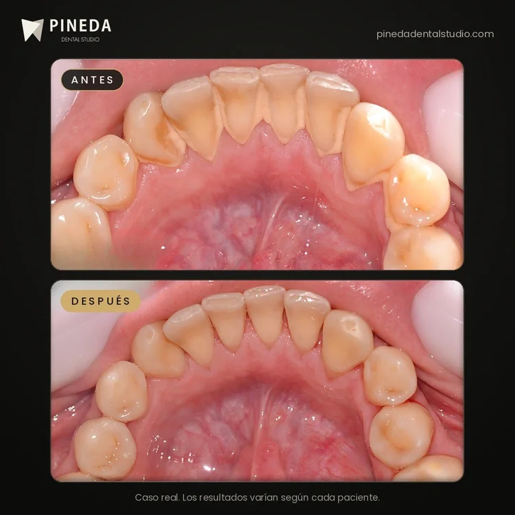 Antes y después de una eliminación de sarro en Pineda Dental Studio, Recoleta, CABA.