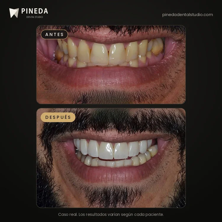 Antes y después de carillas dentales sin desgaste en Pineda Dental Studio, Recoleta, CABA.