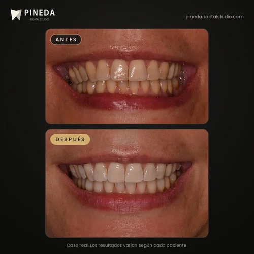Antes y después de un blanqueamiento dental en Pineda Dental Studio, Recoleta, CABA